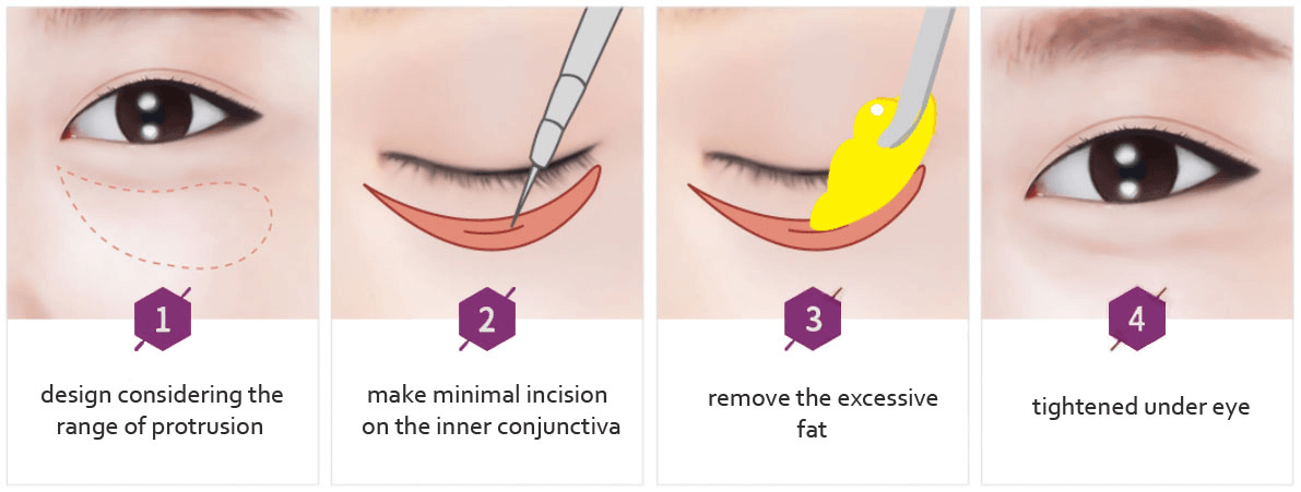Under Eye Correction - Fat repositioning / removal
