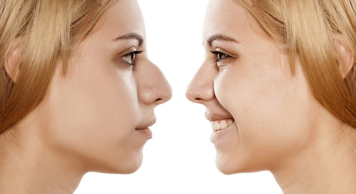 Corrective Rhinoplasty for Previous Surgeries