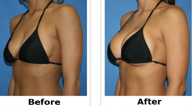 breast augmentation korea before and after