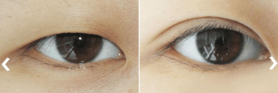 Double Eyelid Surgery in Korea: Costs, Before & After ... from minaplas...