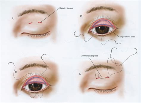 Double Eyelid Non-Incisional Surgery